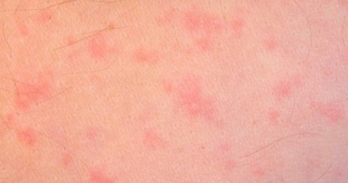 allergy rash